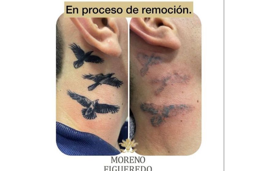 Borrar tatuajes antes y después - 844310