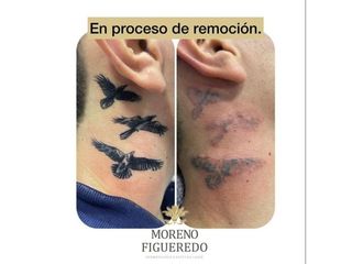 Borrar Tatuajes - Moreno Figueredo