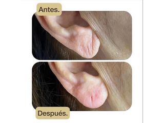 Rejuvenecimiento del lóbulo de la oreja - Moreno Figueredo