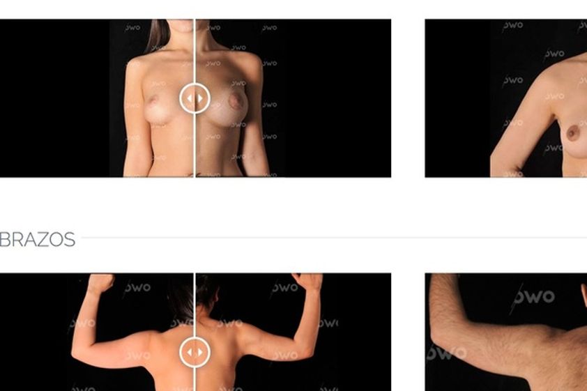 Mamoplastia de aumento antes y después - 580468