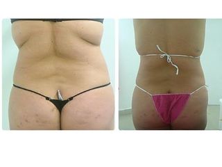 Hidrolipoclasia 
