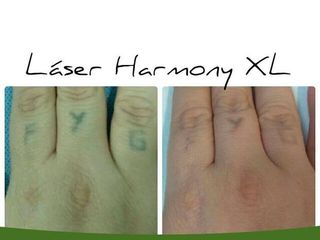 Antes y despues de laser harmony XL