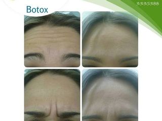 Antes y despues de botox