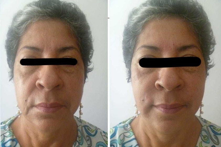 Plasma rico en plaquetas antes y después - 645063
