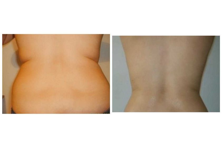 Criolipólisis antes y después - 646986