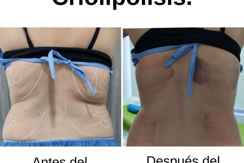 Criolipólisis antes y después - 741062