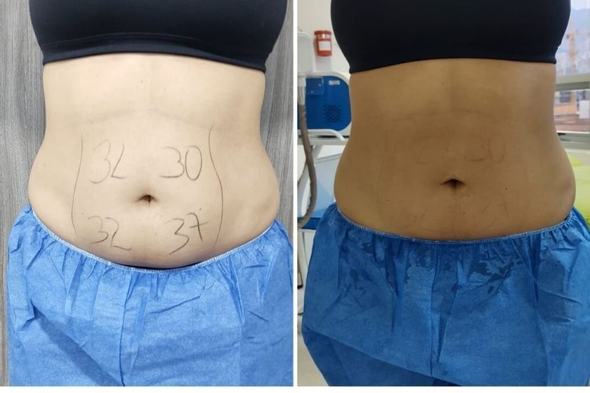 Criolipólisis antes y después - 741063