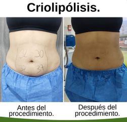 Criolipólisis - Kairos Salud Integral