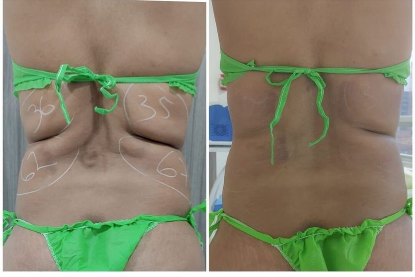 Criolipólisis antes y después - 741460