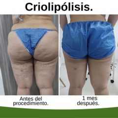 Criolipólisis - Kairos Salud Integral