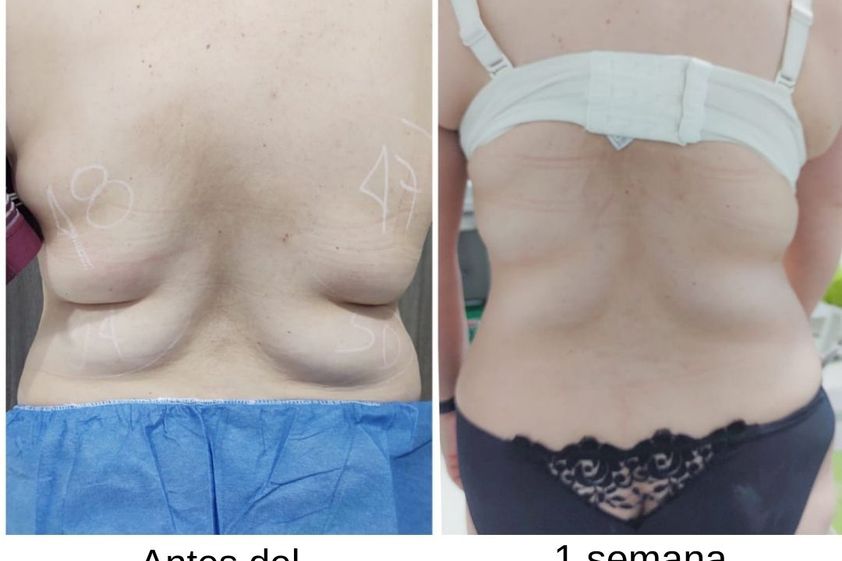 Criolipólisis antes y después - 775552