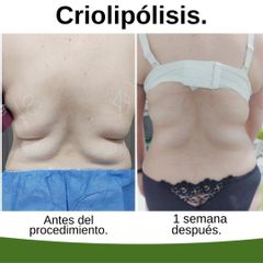 Criolipólisis - Kairos Salud Integral