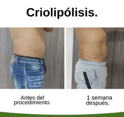 Criolipólisis - Kairos Salud Integral