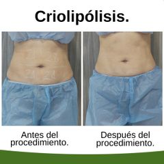 Criolipólisis - Kairos Salud Integral