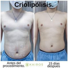 Criolipólisis - Kairos Salud Integral