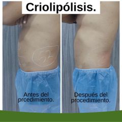 Criolipólisis - Kairos Salud Integral