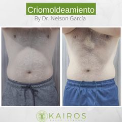Criolipólisis - Kairos Salud Integral