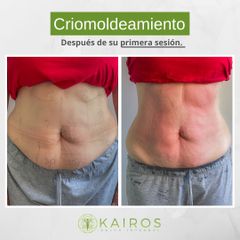 Criolipólisis - Kairos Salud Integral