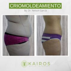 Criolipólisis - Kairos Salud Integral