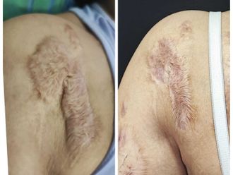Cicatrices antes y después - 837633