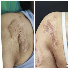 Cicatriz queloide