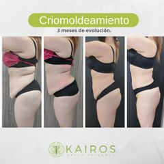 Moldeamiento corporal