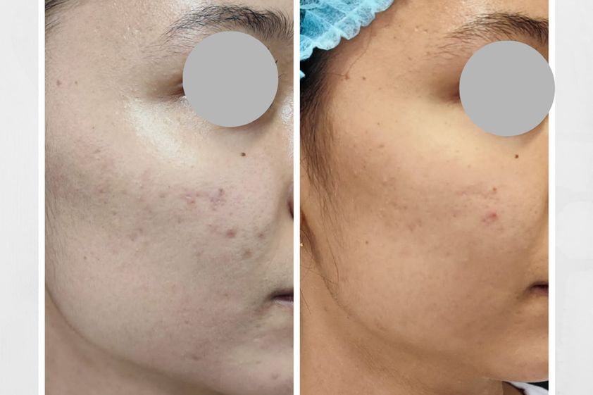Peeling antes y después - 837638