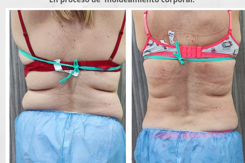Criolipólisis antes y después - 837640
