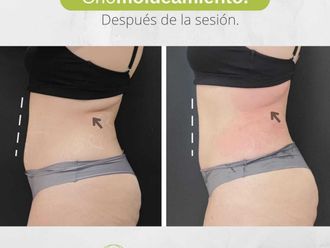 Criolipólisis antes y después - 844898