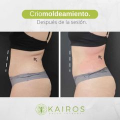 Criolipólisis - Kairos Salud Integral