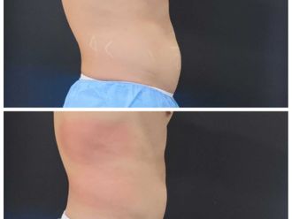 Criolipólisis antes y después - 844900