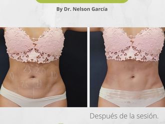 Criolipólisis antes y después - 850544