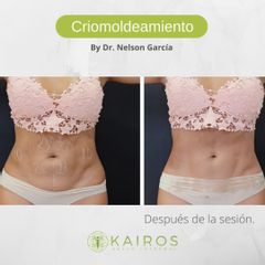 Criolipólisis - Kairos Salud Integral
