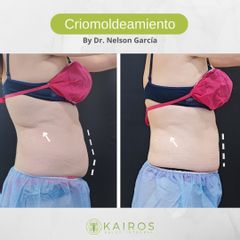 Criolipólisis - Kairos Salud Integral