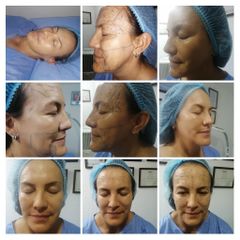 HIFU - BodySkin Care