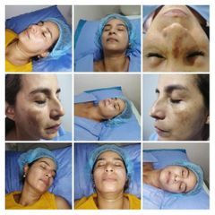 Tratamiento manchas - BodySkin Care