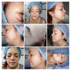 Radiofrecuencia - BodySkin Care