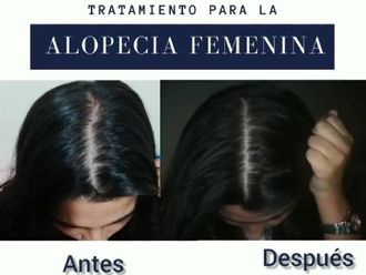 Alopecia - 826571
