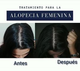 Alopecia - Dr. Giancarlo Fajardo
