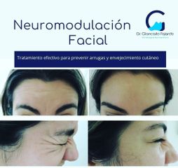 Rejuvenecimiento facial - Dr. Giancarlo Fajardo