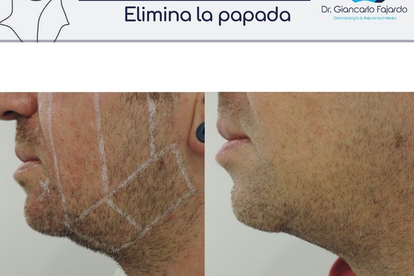 HIFU antes y después - 826575