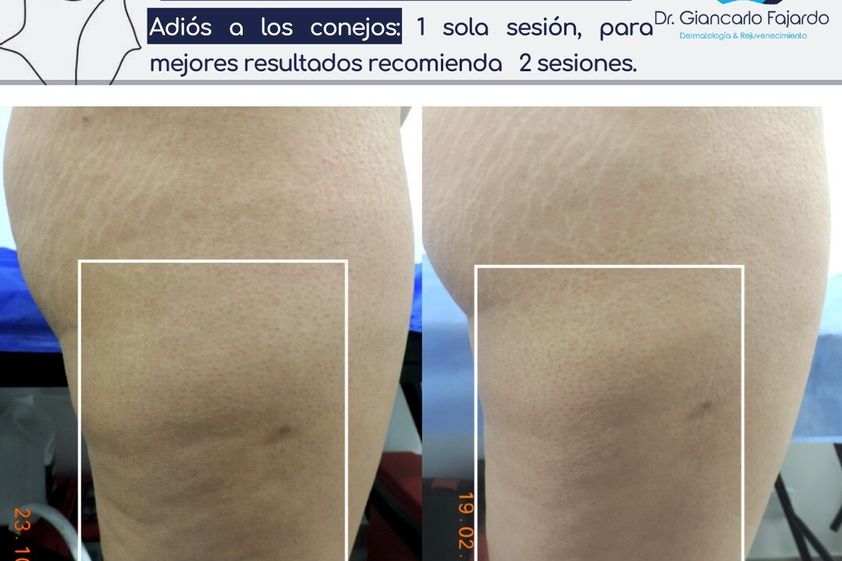 HIFU antes y después - 826581