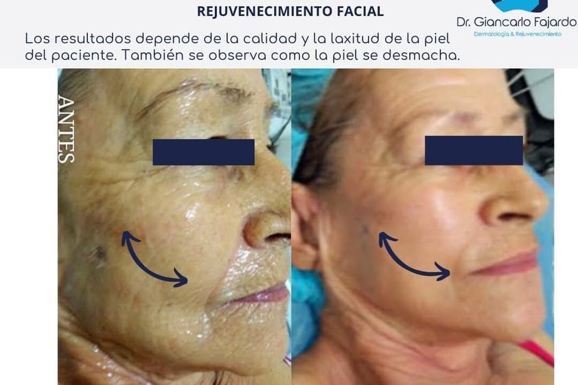 HIFU antes y después - 826951