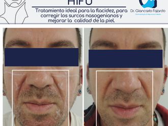 HIFU antes y después - 826955
