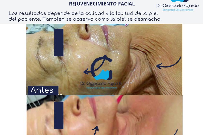 HIFU antes y después - 826957