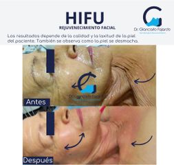 HIFU - Dr. Giancarlo Fajardo