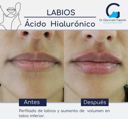Aumento de labios - Dr. Giancarlo Fajardo