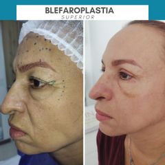 Blefaroplastia - Dr. Harold Gustavo Noriega Garrido