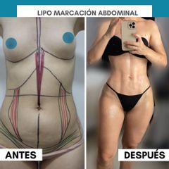 Abdominoplastia - Dr. Harold Gustavo Noriega Garrido