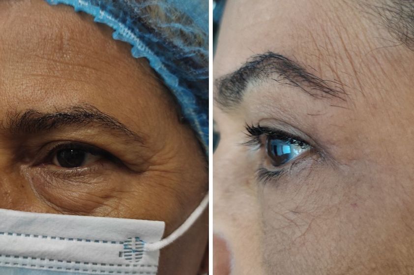 Blefaroplastia antes y después - 839189